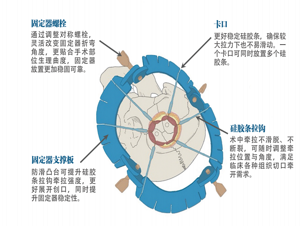 牵开固定器彩页 定稿_01.png