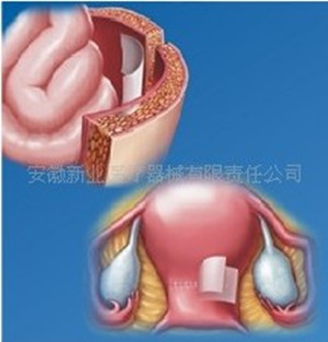 可吸收医用膜（成都迪康）